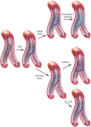 Thumbnail of topic : Complex Angioplasty